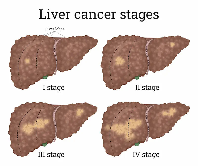 Signs of Liver Cancer Causes, Symptoms, and When to See a Doctor